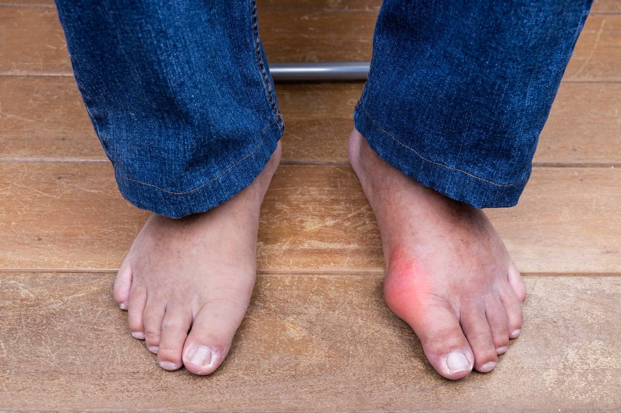 What’s the Connection Between Gout and Diabetes?